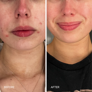 Face comparison; clearer skin after treatment; text: "BEFORE AFTER".