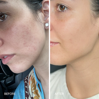 Close-up of a face before and after treatment.